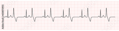 EKG Monitor Showing  Sinus Rhythm with Bigeminy PVC photo