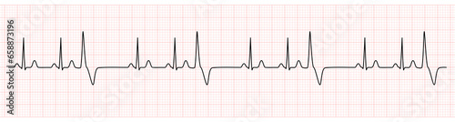 EKG Monitor Showing  Sinus Rhythm with Trigeminy PVC