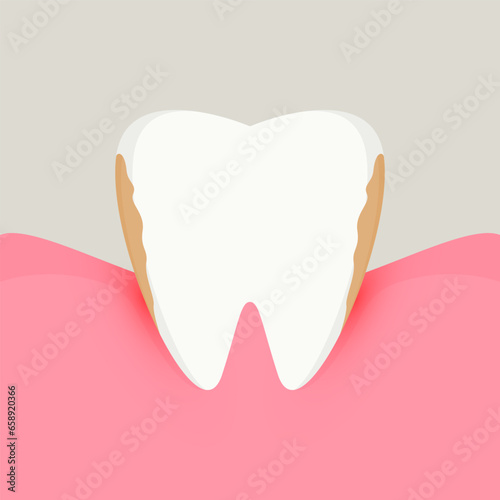 Gum disease. Periodontal disease