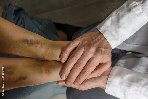 Supporting victims of domestic violence. Female hand with bruises and doctor hand closeup. photo