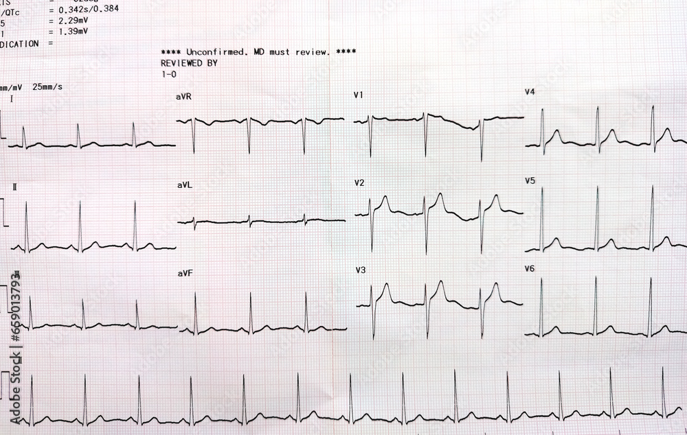 Graph showing the results of the electrocardiogram (EKG) test on recording paper. Graph showing the results of the electrocardiogram (EKG) test on recording paper.
