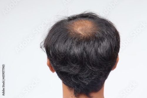 male head with bald head, hair loss, thinning hair or alopecia