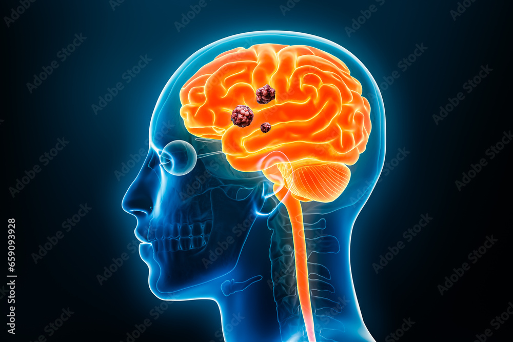 Human brain cancer with cancerous cells or tumors x-ray 3D rendering illustration with body. Anatomy, nervous system pathology, medical, oncology, biology, science, neuroscience, neurology concepts. Human brain cancer with cancerous cells or tumors x-ray 3D rendering illustration with body. Anatomy, nervous system pathology, medical, oncology, biology, science, neuroscience, neurology concepts.
