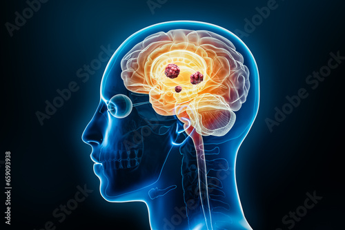 Cancer brain with cancerous cells or tumors x-ray 3D rendering illustration with body. Anatomy, neurological disease, oncology, medical, psychology, science, neuroscience, neurology concepts.