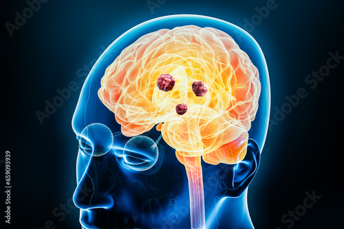 Cancer brain with cancerous cells or tumors x-ray 3D rendering illustration with body. Anatomy, neurological disease, oncology, medical, psychology, science, neuroscience, neurology concepts.