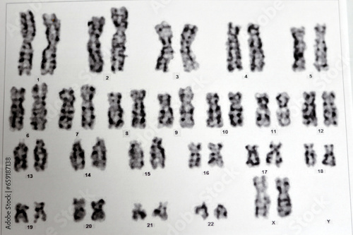 Normal female karyotyping, 46 XX, specimen collected from peripheral blood, a karyotype is the general appearance of the complete set of chromosomes in the cells of a species or in an individual organ