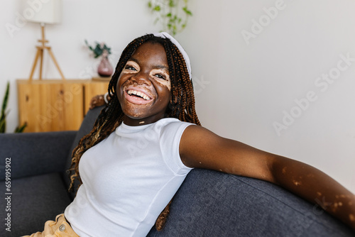 Joyful young teenage girl with vitiligo looking away while relaxing on sofa at home. Diversity and people concept.