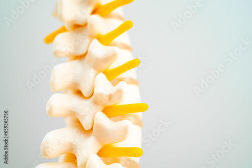 Lumbar spine displaced herniated disc fragment, spinal nerve and bone. Model for treatment medical in the orthopedic department.