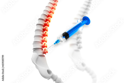 3d illustration of a lumbar spine injection