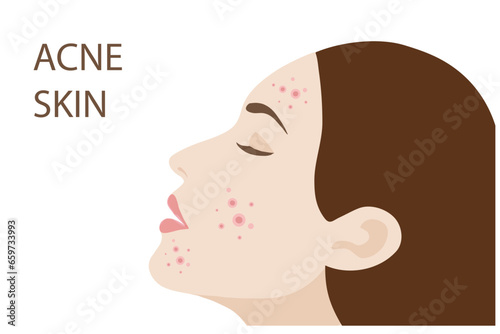 Woman face with skin acne, pimples, blackheads vector illustration. Acne skin face problem concept