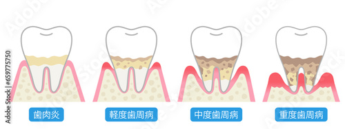 歯周病の進行　症状