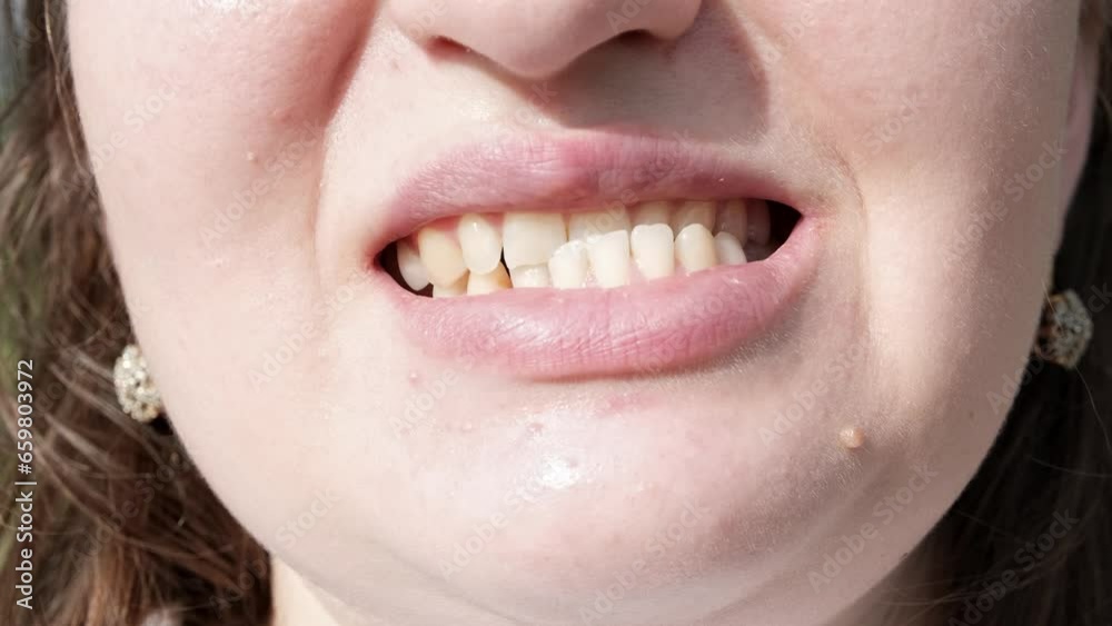 Patient woman with dislocated jaw and malocclusion, temporomandibular