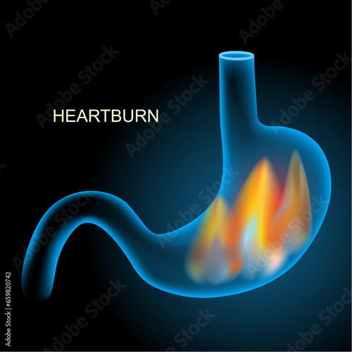 Heartburn. Blue realistic stomach with flame on dark background.