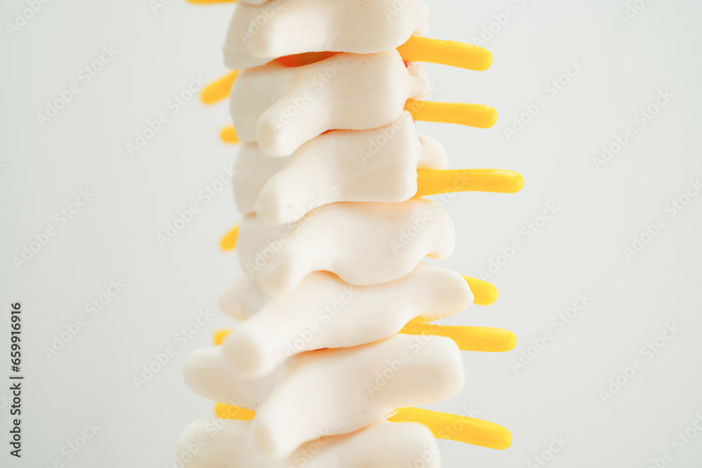 Spinal nerve and bone, Lumbar spine displaced herniated disc fragment, Model for treatment medical in the orthopedic department.