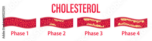 Cholesterol in artery, heart fat, health risk, blood flow, vessels concept. Clogging cholesterol arteries template. Graphic plaque in blood vessels element. Healthcare concept. Vector illustration