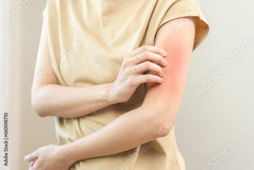 Wallpaper Mural Dermatology asian young woman, girl allergy, allergic reaction from atopic, insect bites on her arm, hand in scratching itchy, itch red spot or rash of skin. Healthcare, treatment of beauty. Torontodigital.ca