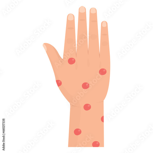 Vector illustration of scabies on hand. Colored vector for website design .Simple design on transparent background (PNG).