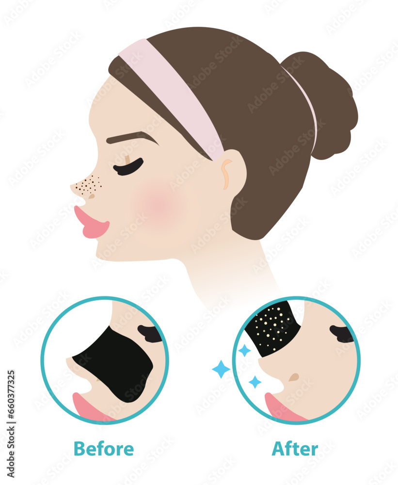 Before and after blackhead pore strip treatment vector illustration