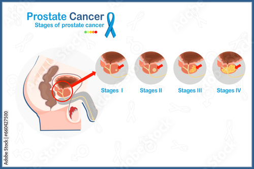Flat medical vector illustration concept of 4 stages of prostate cancer on white background with blue ribbon