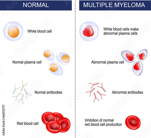 Multiple myeloma