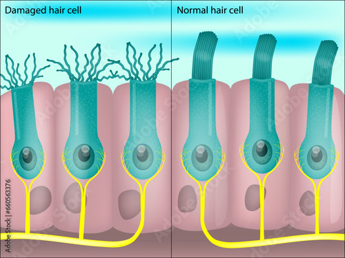 Healthy and damaged hair cells inside cochlea. Noise-induced hearing loss. Tinnitus. 