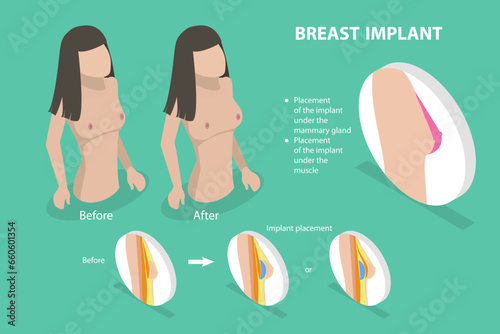 3D Isometric Flat Vector Conceptual Illustration of Breast Implant, Bust Enhancement Operation