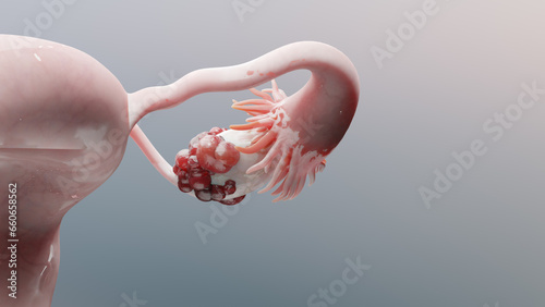 Ovarian malignant tumor, Female uterus anatomy, Reproductive system, cancer cells, ovaries cysts, cervical cancer, growing cells, gynecological disease, metastasis cancerous, duplicating, 3d render photo
