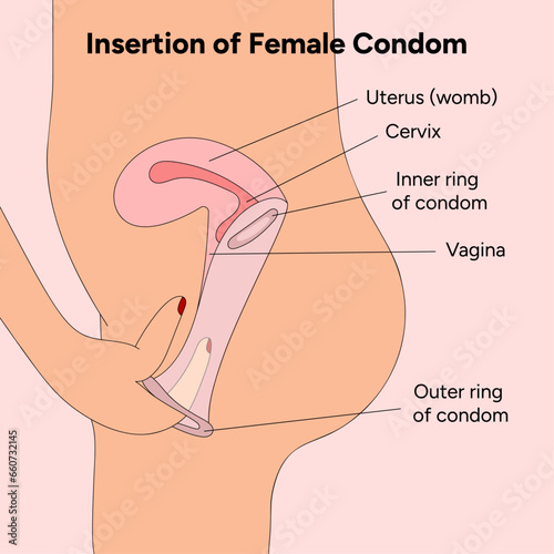 Insertion of female condom, gynecology infographic 
