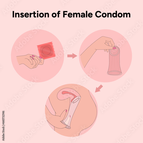 Insertion of female condom, gynecology illustration