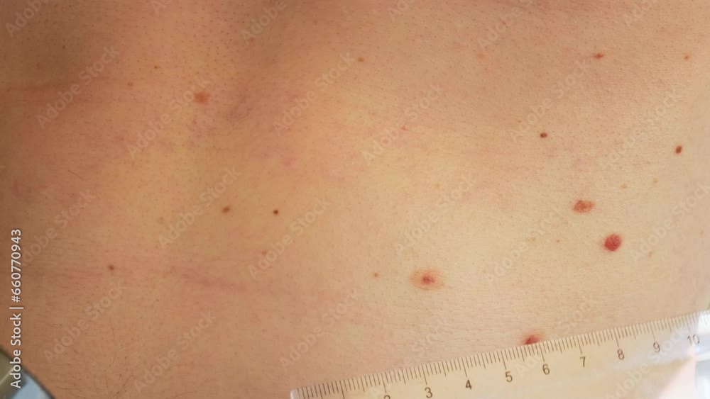 Dermatologist checking male birthmarks with ruler. Doctor examining ...