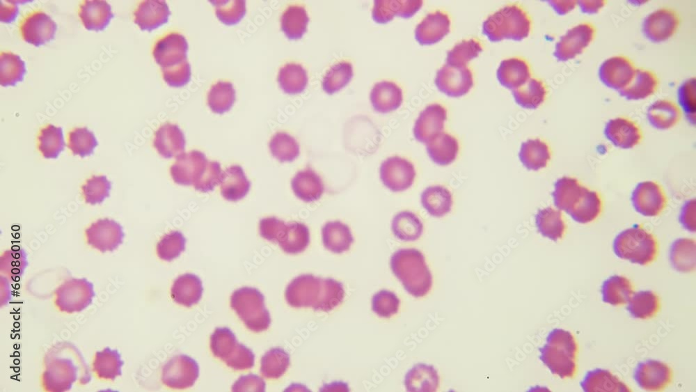 RBC and WBC under microscope. HQ video. Science class. Inspection of human blood components on a fixed and stained sample. Biochemical laboratory. High performance sport. 1000x times magnification