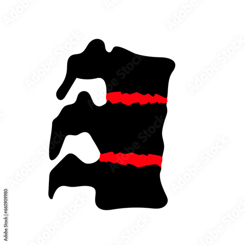 Ankylosing spondylitis disease