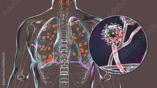 Lung histoplasmosis, a fungal infection caused by Histoplasma capsulatum, 3D illustration photo