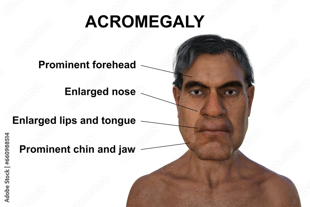 Obraz premium Acromegaly in a man, 3D illustration