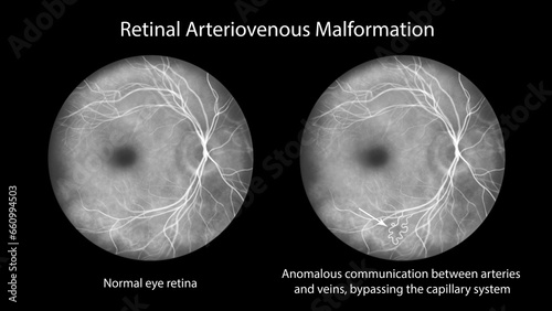 Retinal arteriovenous malformation, illustration
