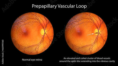 A prepapillary vascular loop on the retina, 3D illustration