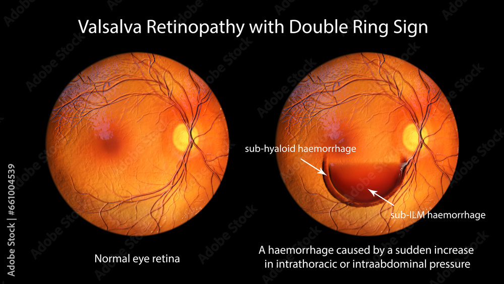 Valsava retinopathy, a preretinal hemorrhage caused by a sudden increase in intraocular pressure, 3D illustration