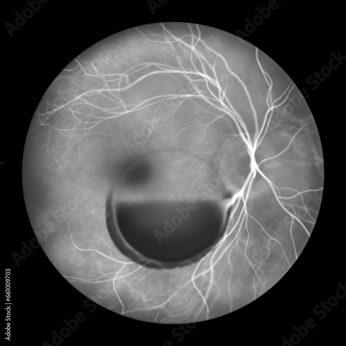 Valsava retinopathy, a preretinal hemorrhage caused by a sudden increase in intraocular pressure, illustration photo