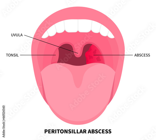 Throat abscess swelling of tonsil gland that cause by bacterial infection with medical examination photo