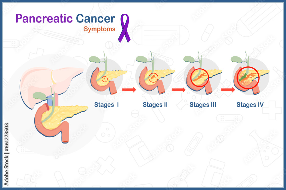 Flat illustration in healthcare concept of pancreatic cancer. Purple ribbon symbol pancreatic cancer and the 4 stages of pancreas,isolated on white background.