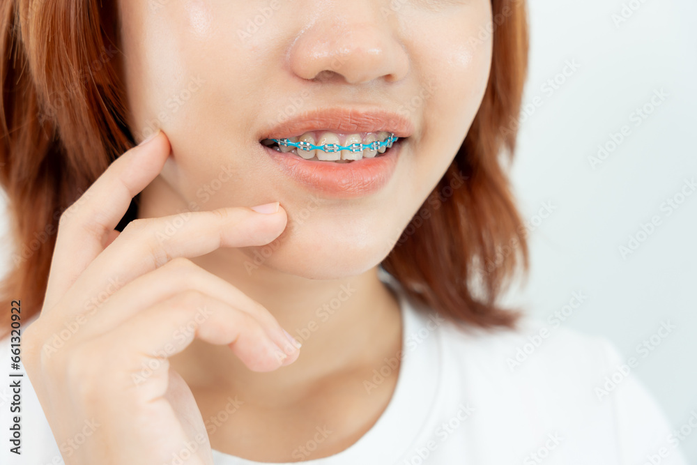 Fototapeta premium Treatment. Dental Care. Beautiful asian Woman Healthy Smile.Metal Brackets on Teeth. young Female Smile with Braces and show beautiful of teeth, Care after braces, confident in orthodontics