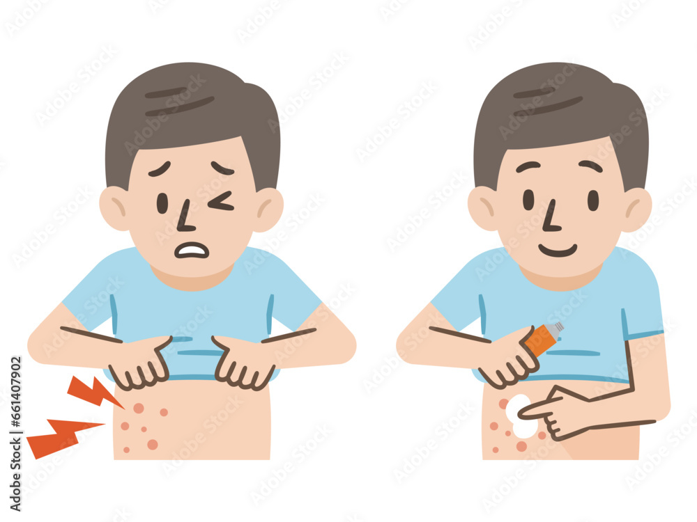湿疹の症状と薬を塗る男性のイラスト 湿疹の症状と薬を塗る男性のイラスト