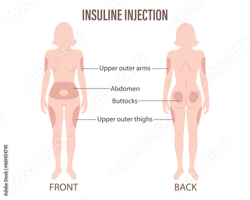 Diabetes. Insulin injection sites on the human body, upper arms, abdomen, buttocks, upper thighs. Medical infographic banner, poster