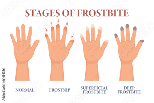 Fototapeta Naklejka Na Ścianę i Meble -  Frostbite stages. Frozen hands in different stages. Medical frostbite. Skin burn symptom. Health care medical concept. Vector