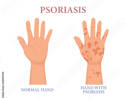 Psoriasis, healthy and unhealthy hand. Dermatology. The concept of medicine and healthcare. Poster, banner, vector
