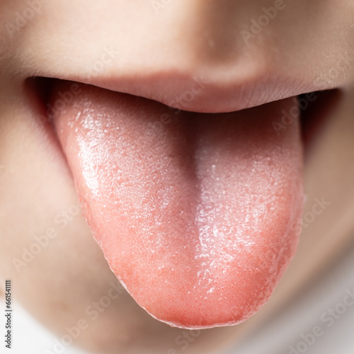 The tongue of a six-year-old healthy child, papillae on the tongue photo