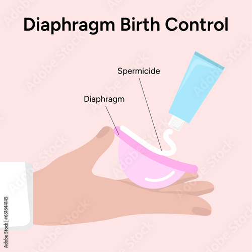 Diaphragm birth control, diaphragmwith spermicide 