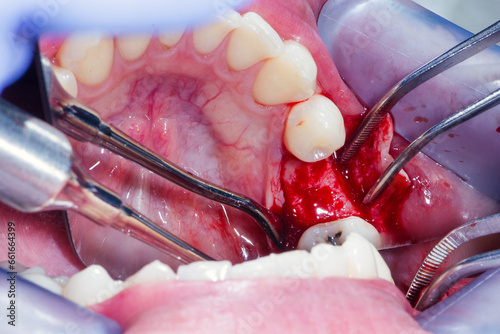 Fototapeta Naklejka Na Ścianę i Meble -  Opened mandibular bone after surgical incision of the gums with a scalpel before dental implantation