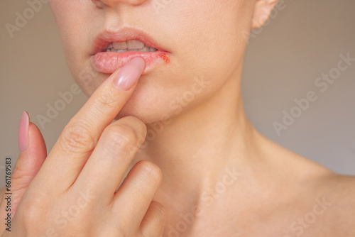 a close-up photo of a young woman s face  she shows herpes on her lips. The stage of exacerbation. Isolated on a beige background.