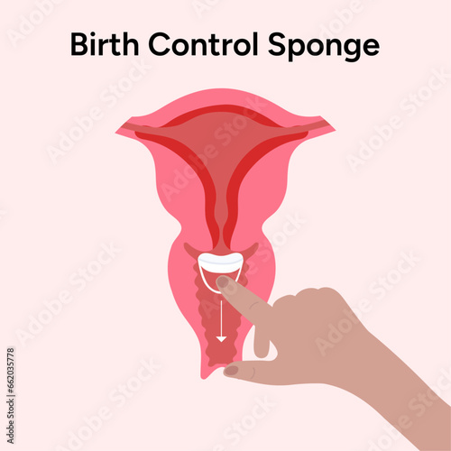 Birth control sponge illustration correct place 